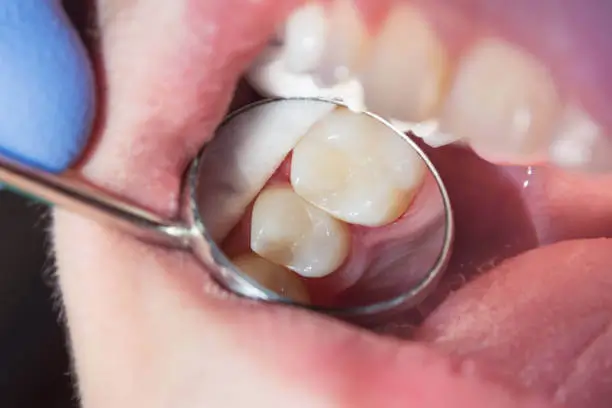 enhancing smiles with white fillings for teeth