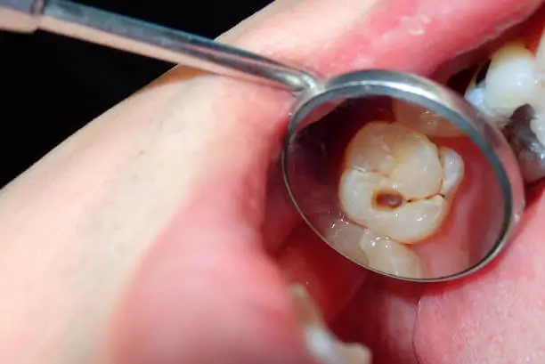 tooth cavity symptoms sensations & early warning signs