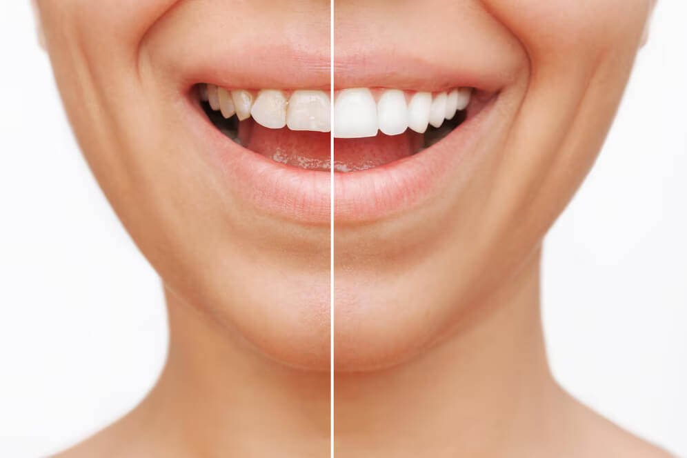 the before and after of veneers