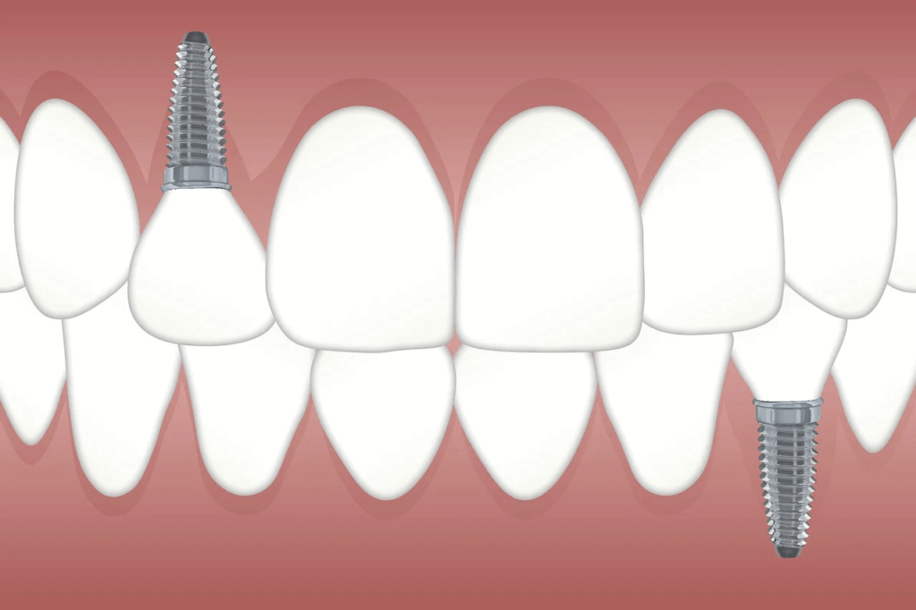 a close up image of a dental implant